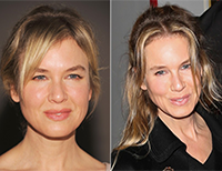 The Science Behind Renée Zellweger's New Face